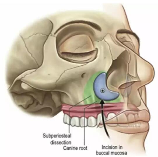 梨状孔旁假体植入改善鼻整形的整体效果(文献分享)