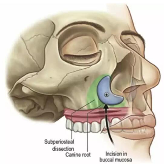 方法:可以在局麻或者全麻下进行,梨状孔外侧,上颌龈颊沟上缘1cm切口
